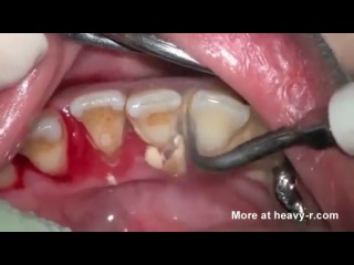 removal of tartar.